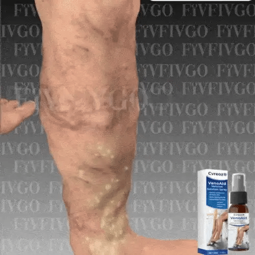 South Moon - Varicose Veins Spray for pain relief