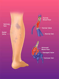 South Moon - Varicose Veins Spray for pain relief